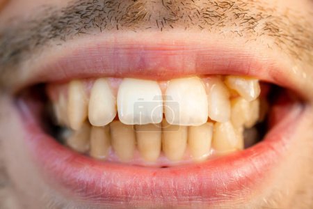 Foto de Close up of man's face with crooked teeth before install braces. Teeth need ortodontic treatment. - Imagen libre de derechos