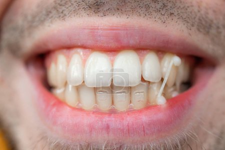 Téléchargez les photos : Le jeune homme utilise un élastique orthodontique sur ses dents pour corriger sa morsure. Concept dentaire. - en image libre de droit