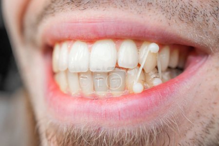 Foto de Young man pulls orthodontic elastics on his teeth to correct his bite. Dental concept. Isolated - Imagen libre de derechos