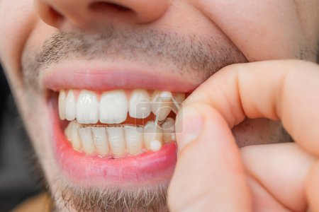 Foto de Close-up of man wearing orthodontic elastic band - Imagen libre de derechos