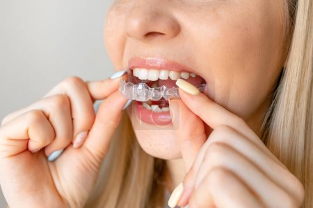 Photo for Closeup of woman's mouth putting on a transparent retainer with soft natural lighting - Royalty Free Image