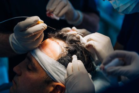 Proceso de operación de trasplante de cabello con cirujano.