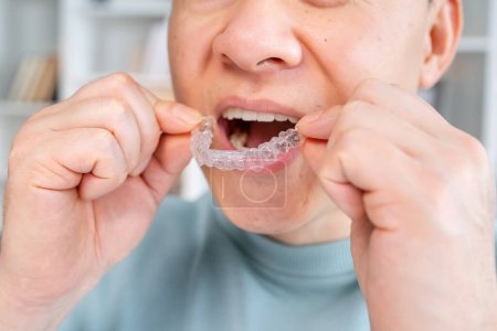 Téléchargez les photos : Gros plan de l'aligneur de dents transparentes en silicone orthodontique dans les mains des hommes. Support pour le blanchiment des dents. Photo recadrée. - en image libre de droit
