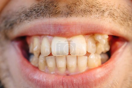Téléchargez les photos : Dents masculines courbes, avant d'installer des accolades. Gros plan des dents avant le traitement par un orthodontiste - en image libre de droit