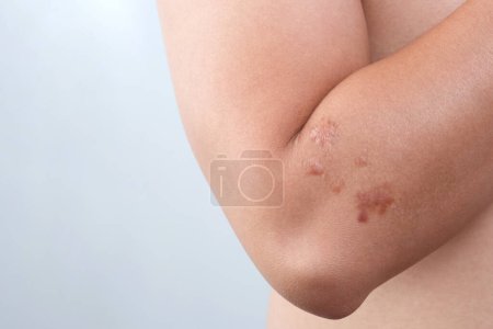 Photo for Man arm scar caused by surgery - Royalty Free Image