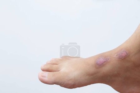 Photo for Scars are formed as a result of the process of healing the body's wounds. Whether it is wounds from accidents, surgical wounds or scald burns. - Royalty Free Image