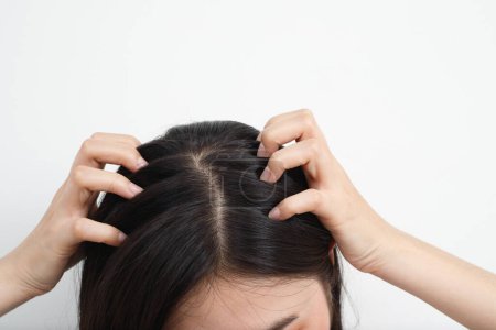 Foto de Una mujer tiene problemas con el cabello y el cuero cabelludo, tiene caspa de reacciones alérgicas a los champús. y acondicionador capilar - Imagen libre de derechos