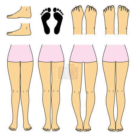 Ilustración de Pie y pierna, golpear las rodillas, piernas de arco y piernas normales, pie plano, juanete, y pie normal, conjunto de archivos vectoriales - Imagen libre de derechos