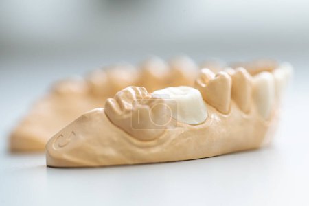 Téléchargez les photos : Couronne en céramique dentaire Solo sur le modèle en pierre dentaire - en image libre de droit