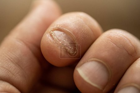 Photo for Onychophagy. Close up of fingers with eaten nail. Anxiety and nerves. - Royalty Free Image