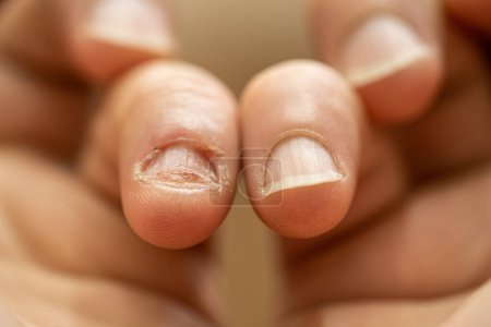 Foto de Onicofagia. Cierre de dedos con clavo comido. Ansiedad y nervios. - Imagen libre de derechos