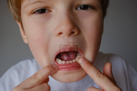 Téléchargez les photos : Closeup portrait of a kid showing his teeth with Cavities problem - en image libre de droit