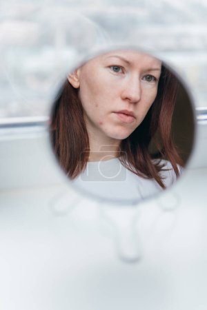 Téléchargez les photos : Femme blanche avec l'acné regarde dans le miroir - en image libre de droit