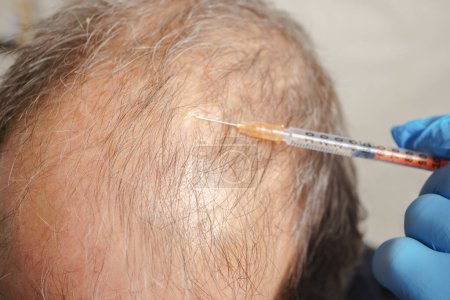Foto de Hombre calvo tratamiento capilar inyección - Imagen libre de derechos