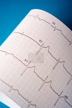 Téléchargez les photos : Électrocardiogramme imprimé sur papier sur une table bleue. - en image libre de droit