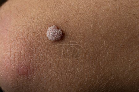 Photo for Macro Shot of Wart on Arm - Royalty Free Image