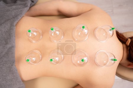Photo for Womans back with vacuum jars at a massage session - Royalty Free Image