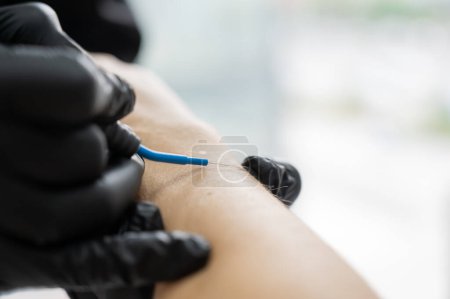 Téléchargez les photos : Dermatologist removes a mole on a patients arm using an electrocoagulator - en image libre de droit
