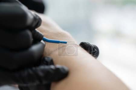 Dermatologist removes a mole on a patients arm using an electrocoagulator