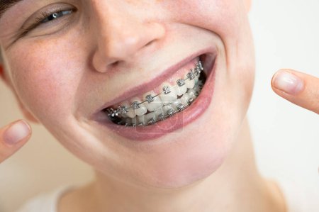 Photo for Close-up portrait of a young woman pointing at a smile with braces on her teeth - Royalty Free Image