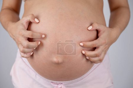 Téléchargez les photos : Une femme se gratte le ventre. Allergies cutanées pendant la grossesse - en image libre de droit