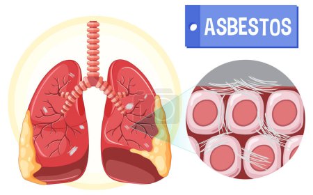 Téléchargez les illustrations : Schéma montrant l'asbestose dans les poumons illustration - en licence libre de droit