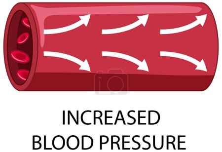 Téléchargez les illustrations : Flux sanguin avec augmentation de la pression artérielle illustration texte - en licence libre de droit