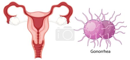 Ilustración de Infección vaginal bacterias concepto ilustración - Imagen libre de derechos