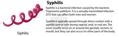 Illustration for Syphilis virus with explanation illustration - Royalty Free Image
