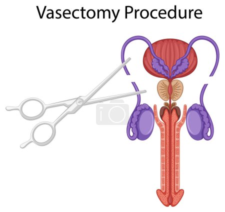 Ilustración de Dentro del sistema reproductor masculino ilustración - Imagen libre de derechos