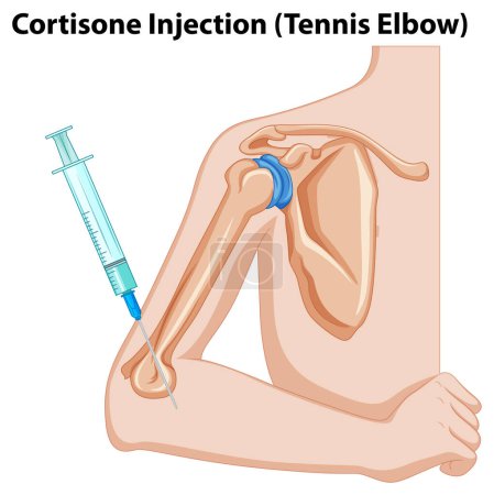 Illustration for Cortisone Injection (Tennis Elbow) diagram illustration - Royalty Free Image