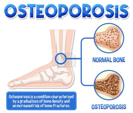 Ilustración de Cartel informativo de Osteoporosis ilustración ósea humana - Imagen libre de derechos