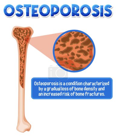 Illustration for Informative poster of Osteoporosis human bone illustration - Royalty Free Image