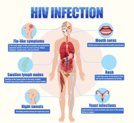 Téléchargez les illustrations : Affiche d'information sur l'infection à VIH illustration - en licence libre de droit