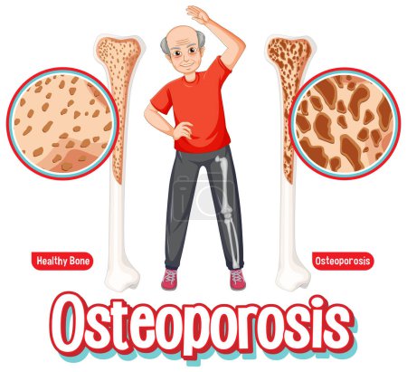 Vergleich von normalem Knochen und Knochen mit Osteoporose bei alten Menschen Abbildung