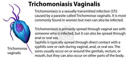 Illustration for Trichomoniasis Vaginalis with explanation illustration - Royalty Free Image