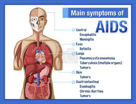 Illustration for Informative poster of main symtoms of AIDS illustration - Royalty Free Image