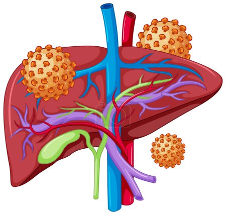 Illustration for Hepatitis B liver infection virus illustration - Royalty Free Image