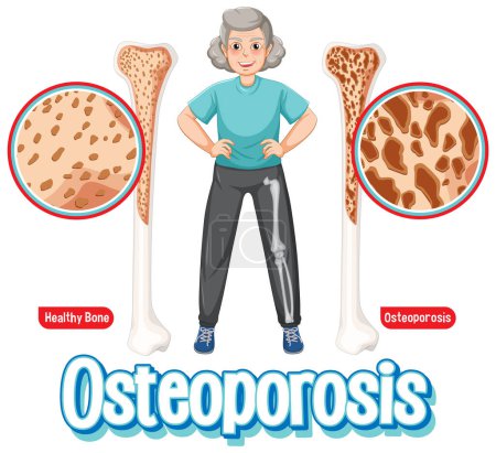 Illustration for Comparison of normal bone and bone with Osteoporosis in old people illustration - Royalty Free Image