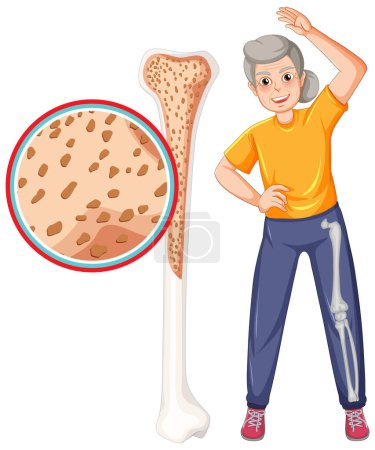 Illustration for Osteoporosis in old people illustration - Royalty Free Image