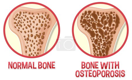 Vergleich von normalem Knochen und Knochen mit Osteoporose