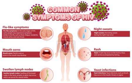Ilustración de Cartel informativo de los síntomas comunes de la ilustración del VIH - Imagen libre de derechos