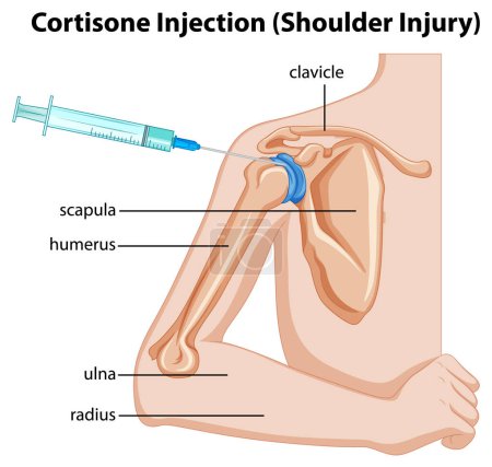 Ilustración de Ilustración del diagrama de inyección de cortisona (lesión en el hombro) - Imagen libre de derechos