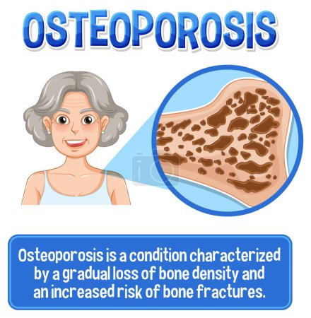 Illustration for Informative poster of Osteoporosis human bone illustration - Royalty Free Image