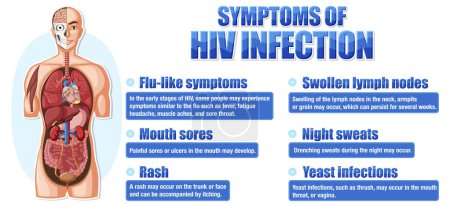 Ilustración de Cartel informativo de los principales síntomas de la ilustración del VIH - Imagen libre de derechos