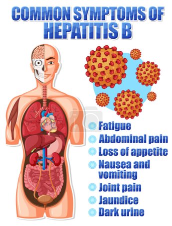 Ilustración de Afiche informativo de síntomas comunes Hepatitis B ilustración - Imagen libre de derechos
