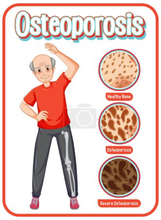 Illustration for Comparison of normal bone and bone with Osteoporosis in old people illustration - Royalty Free Image