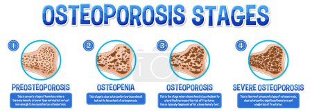 Ilustración de Cartel informativo de Osteoporosis ilustración ósea humana - Imagen libre de derechos