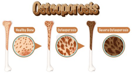 Illustration for Comparison of normal bone and bone with Osteoporosis illustration - Royalty Free Image