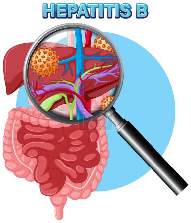 Illustration for Hepatitis B liver infection virus illustration - Royalty Free Image